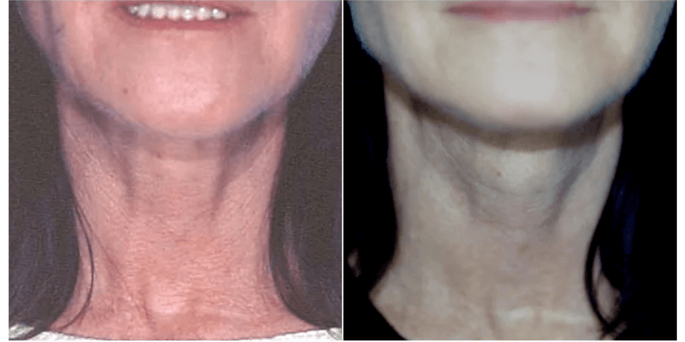 Neck Rejuvination