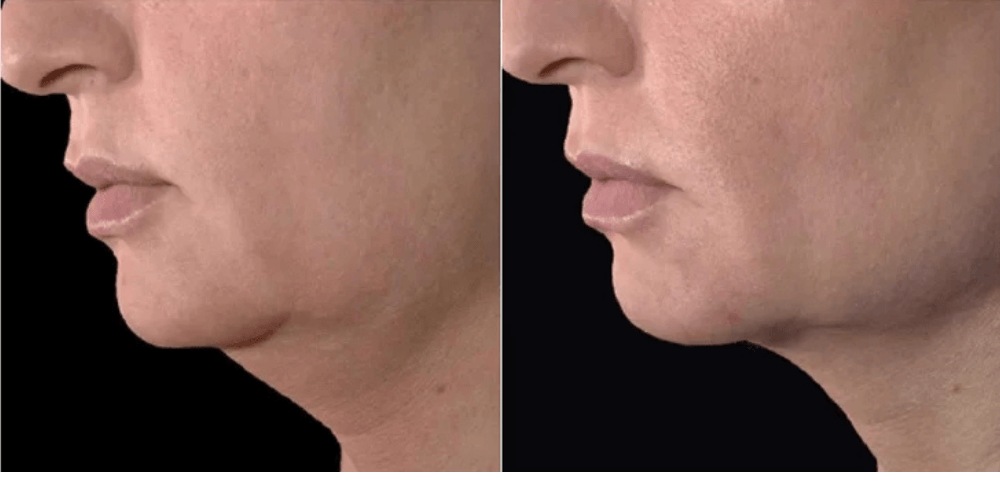 Neck Lift