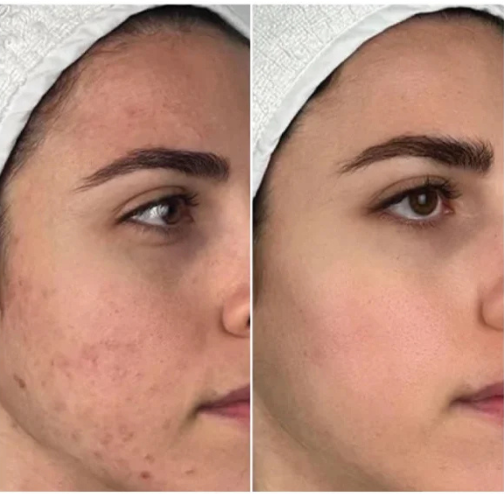 Photodynamic Therapy  (PDT)