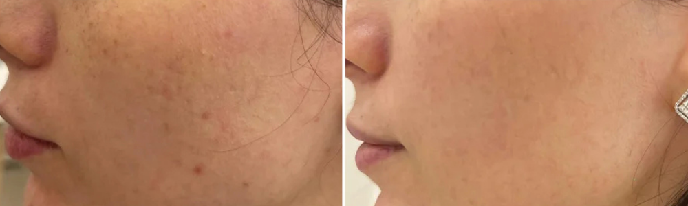 Photodynamic Therapy  (PDT)