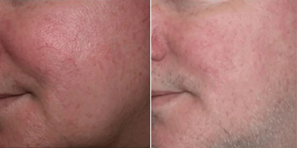 Rosacea Treatment