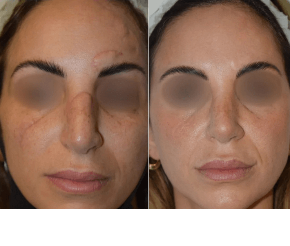 Scar & Stratch Marks