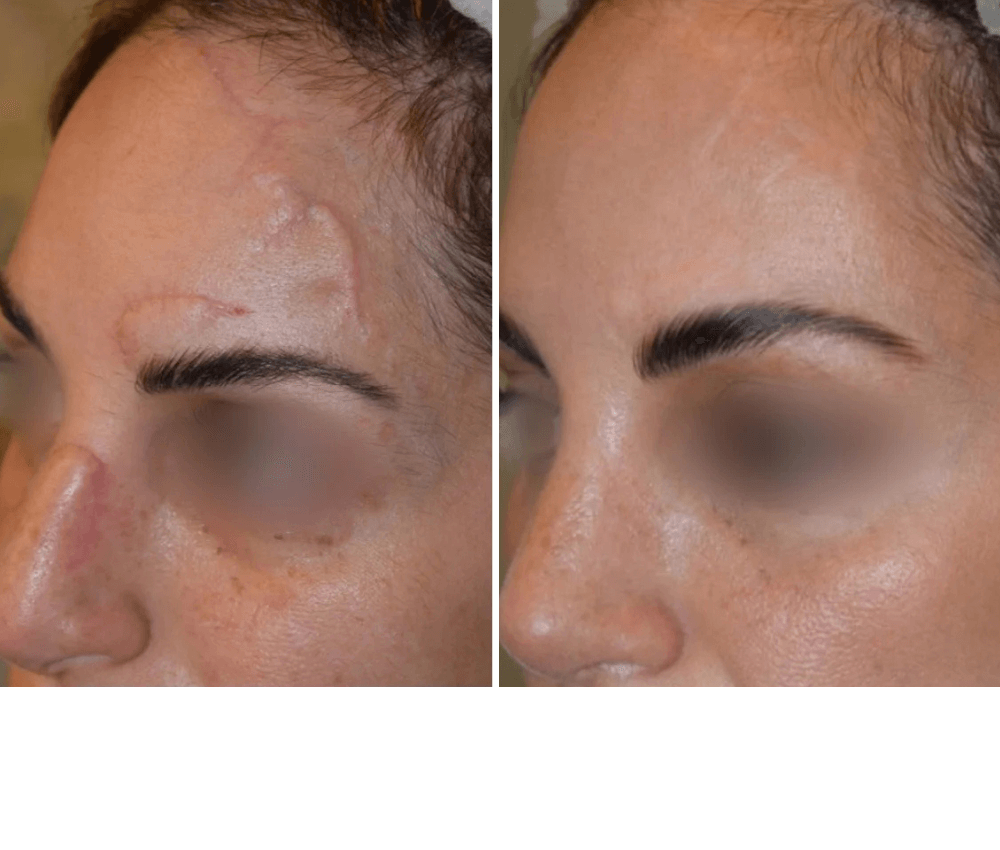 Scar & Stratch Marks