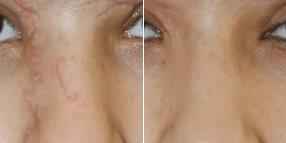 Scar & Stratch Marks