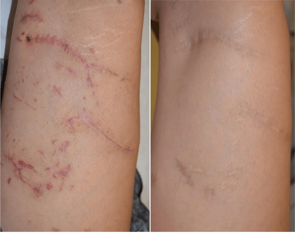 Scar & Stratch Marks