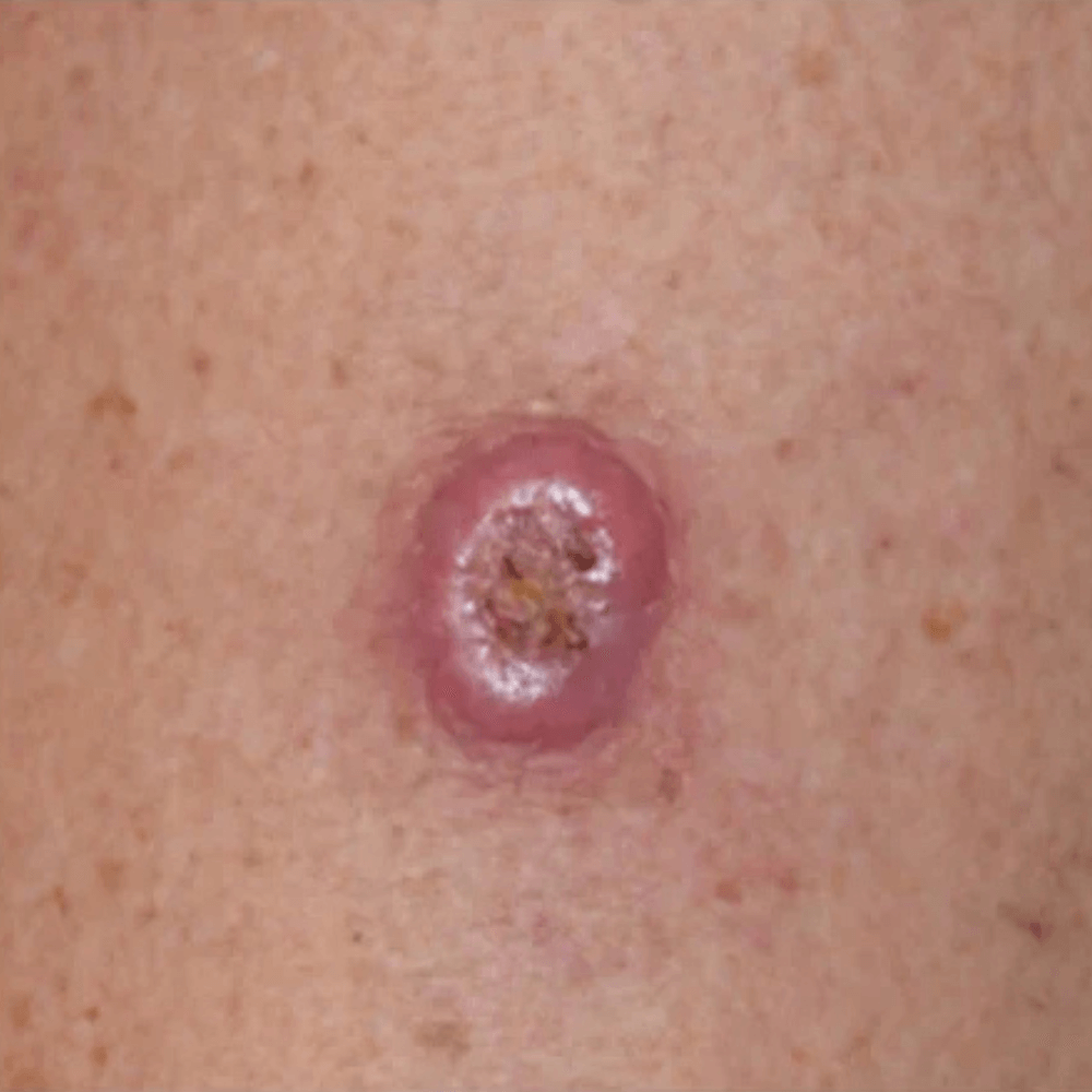 Skin Cancer Treatment