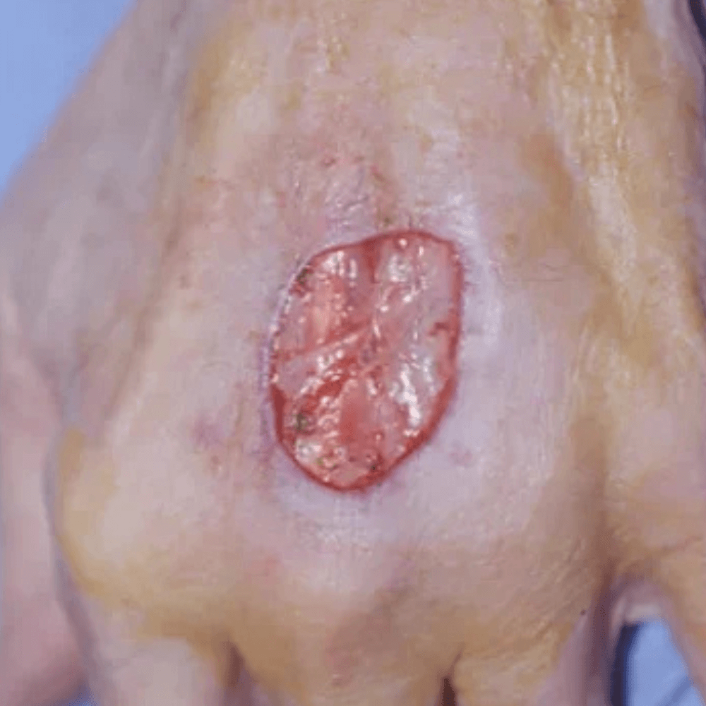 Skin Cancer Treatment