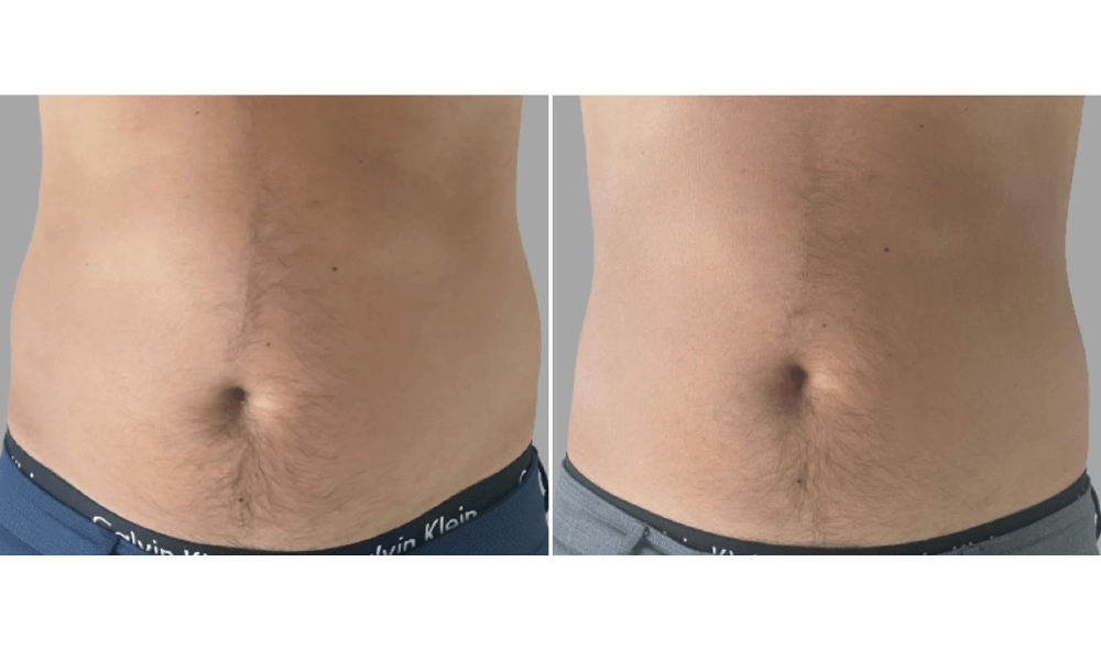 Body Contouring Treatment