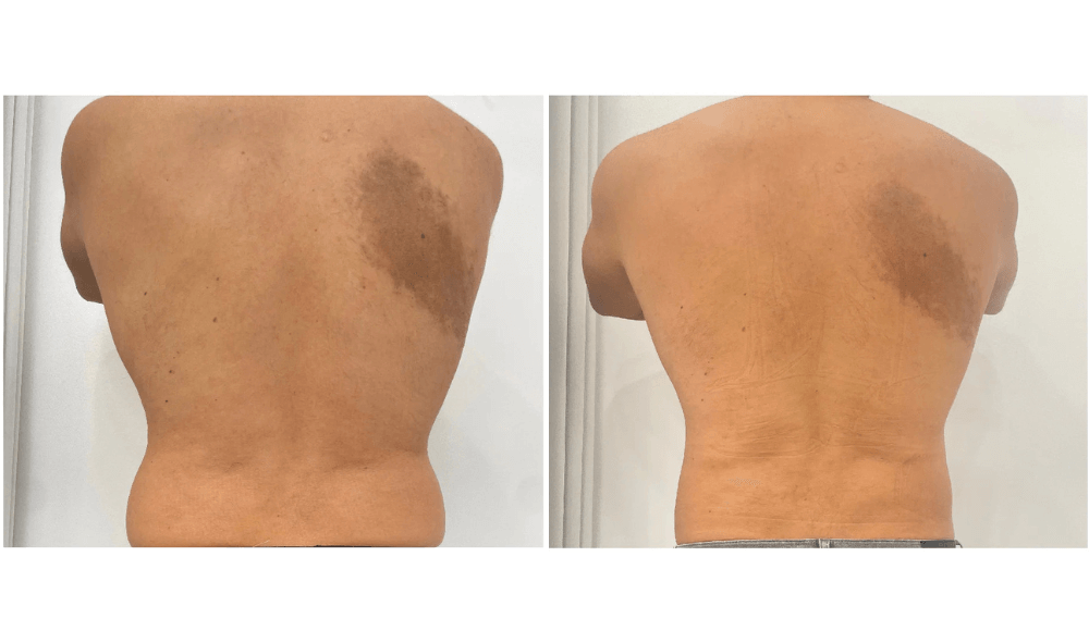 CoolSculpting Procedure