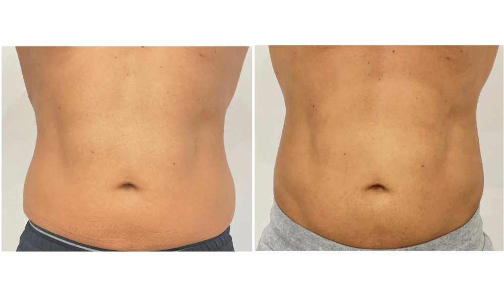 Exilis Elite