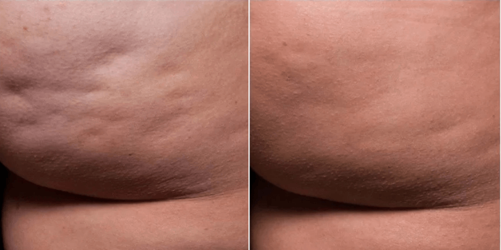 Stretch Marks Removal.png