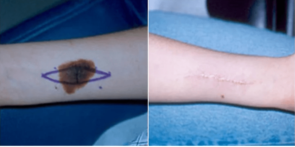 Surgery for Benign Lesions