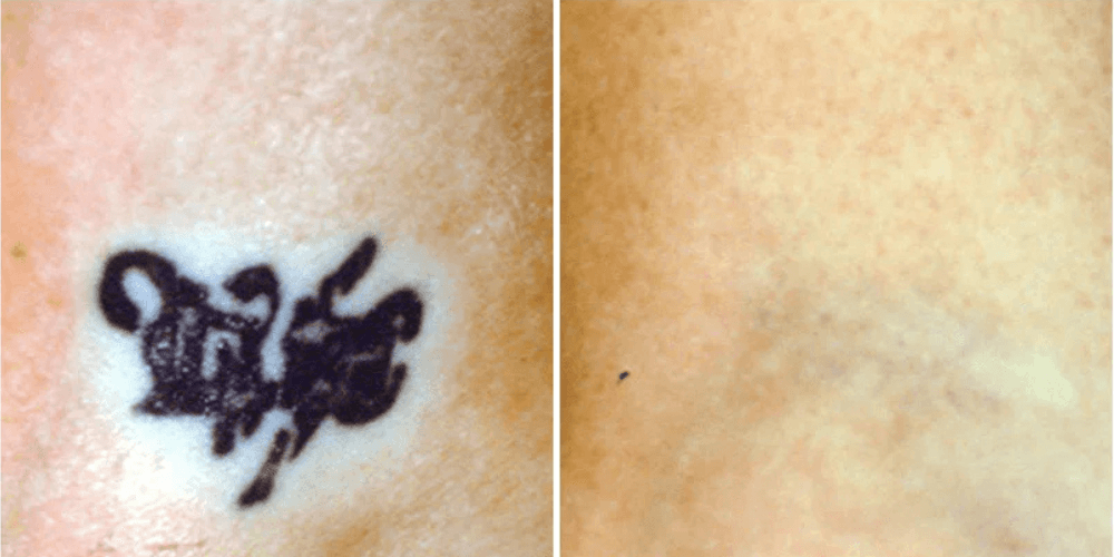 Laser Tattoo Removal Treatment