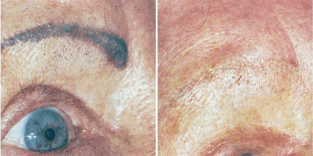 Laser Tattoo Removal Treatment