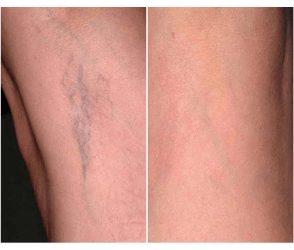 Vascular laser Treatment