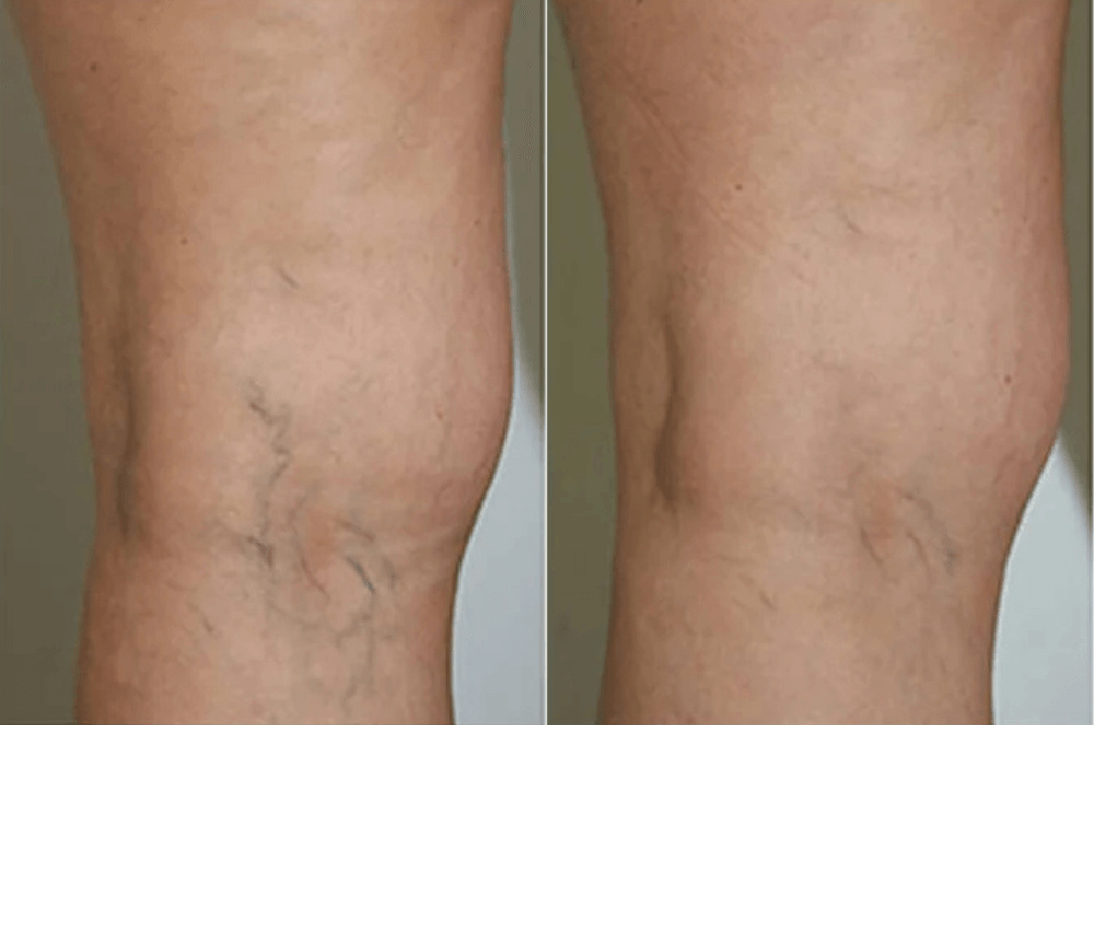 Vascular laser Treatment
